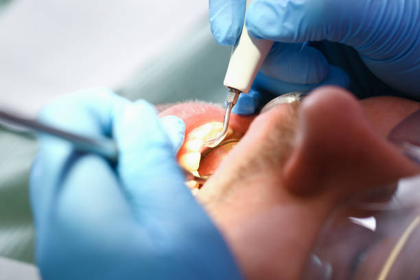 Best Emergency Dental Care for Broken or Chipped Teeth in Wheatland, WY