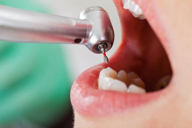 Best Emergency Tooth Extraction in Wheatland, WY